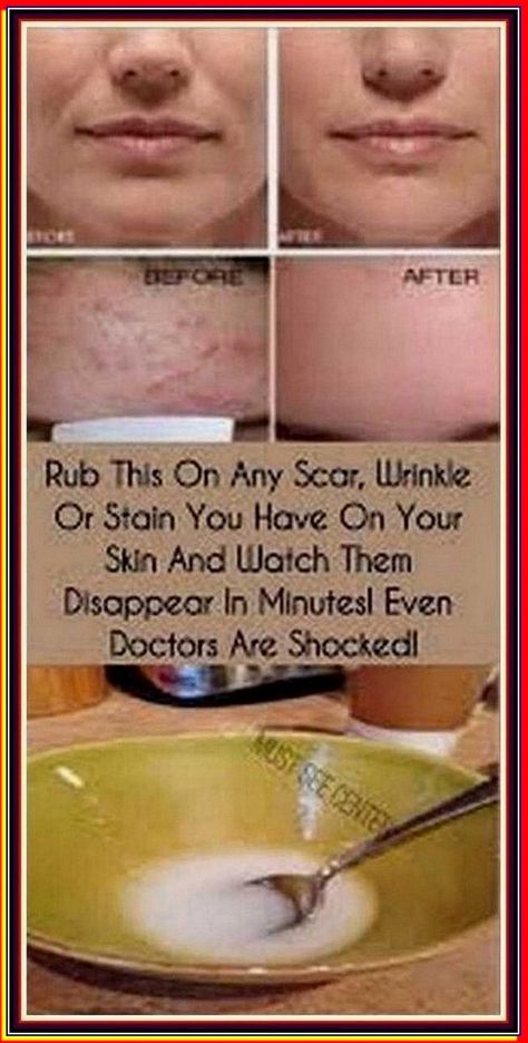 Rub This On Any Scar Wrinkle Or Stain You Have On Your Skin And Watch