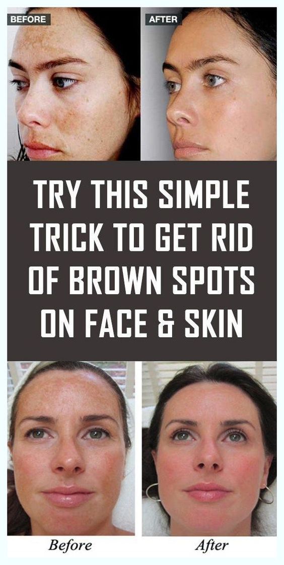 SIMPLE TRICK TO REMOVE BROWN SPOTS FROM YOUR SKIN simple-trick-to-remove-brown-spots-from-your-skin